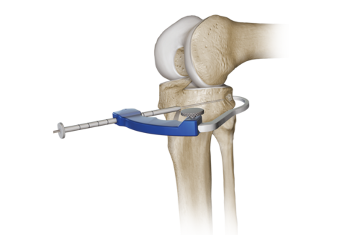 Lateral Collateral Ligament Reconstruction