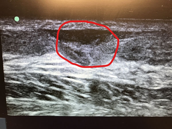 Ultrasound Achilles Tear