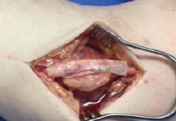 Ulnar Nerve Wrapped in Amnion
