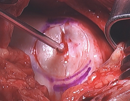 Open View of Chondral Lesion