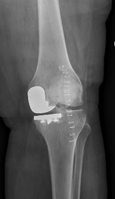 Partial Knee Replacement