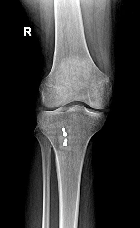 MPFL Reconstruction with Tibial Tubercle Osteotomy 1