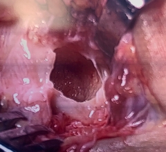 Cored recipient site of talus