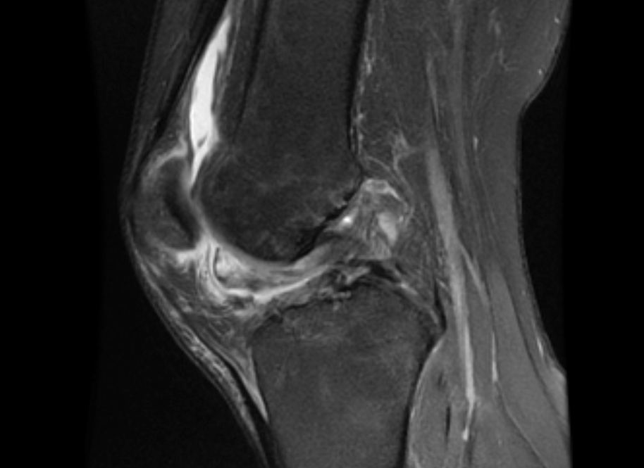 Post-Op MRI Sagittal View