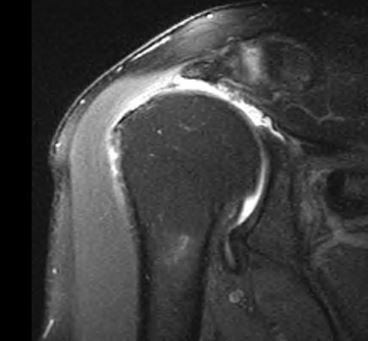 Irreparable Rotator Cuff Tear