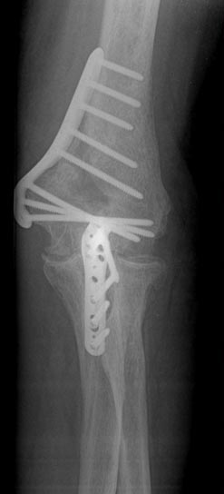 Repair of Non-Union With Plates and Screws