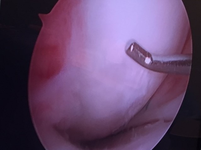 Four months after cartiform to femoral condyle