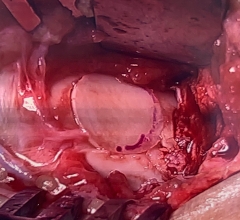 OATs plug implanted into talus