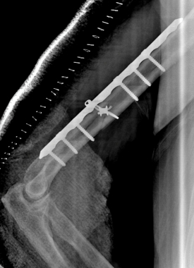 Anatomic surgical repair with plates, screws, and cable