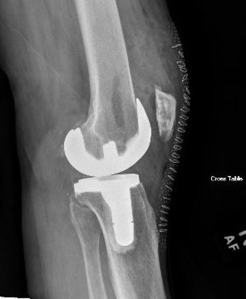 knee replacement 2