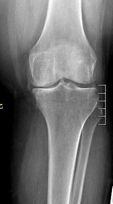 Medial Compartment Arthritis