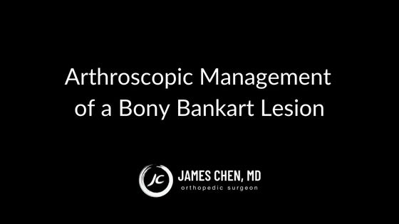 Arthroscopic Management of a Bony Bankart Lesion