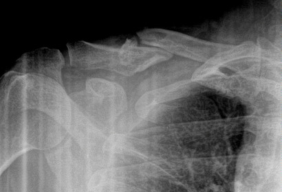 Displaced Clavicle Fracture with Butterfly Fragment
