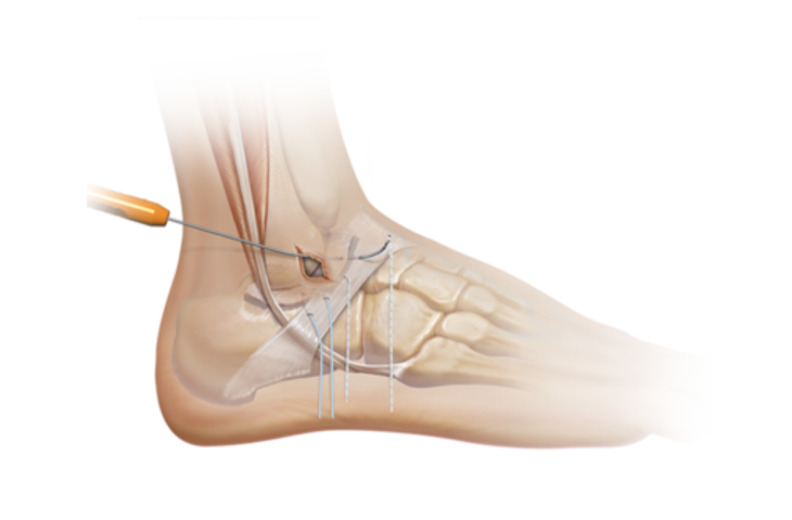 Ankle Stabilization (Brostrom Procedure)