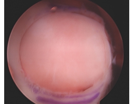 Arthroscopic view of implanted OATs