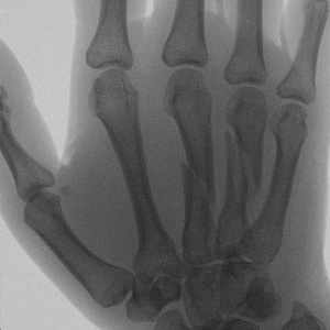 Oblique Metacarpal Fractures