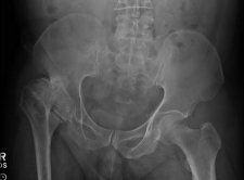 Chronic Collapse & Avascular Necrosis of Right Hip