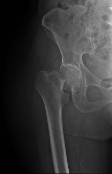 Femoral Neck Fracture