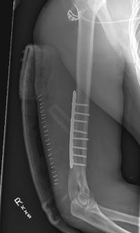 Surgical Repair of Fracture With Plate and Screws