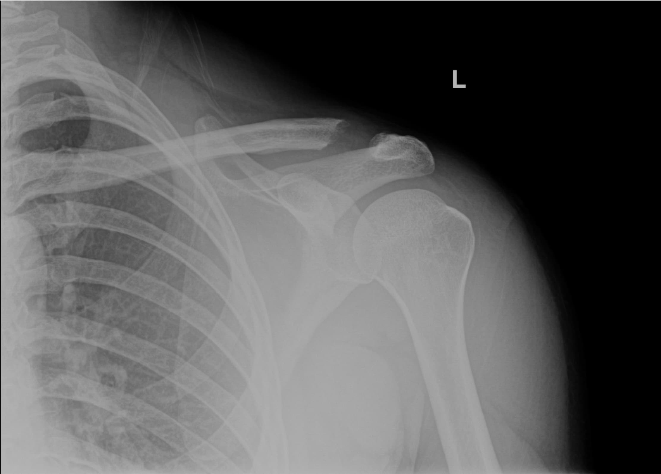 Post-Operative X-RAY of patient clavicle