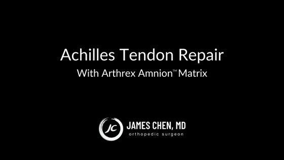Achilles Tendon Repair With Arthrex Amnion™ Matrix