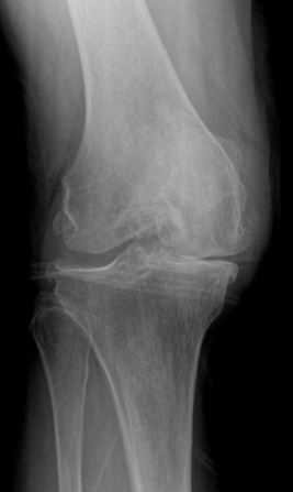 Bone on Bone Osteoarthritis of the Knee