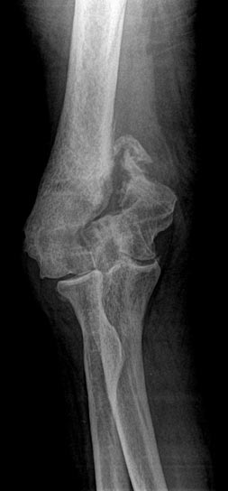 Non-Union of Distal Humerus Elbow Fracture
