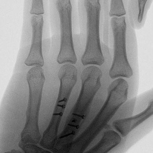 Repair of Metacarpal Fractures with Screws