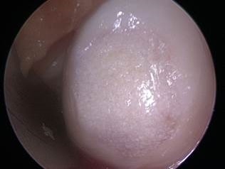 Intra-operative filling of defect with Biologic Cartilage