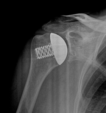 Stemless Total Shoulder Replacement