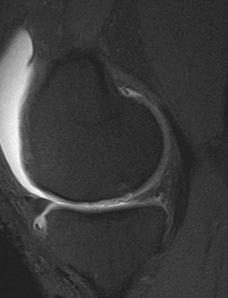 MRI 12 months after cartiform