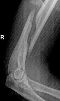 Spiral Fracture of Humerus