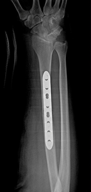Radial Shaft Fracture Fixation with Plate