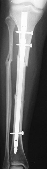 Repair of Tibial Shaft Fracture with Intramedullary Nail