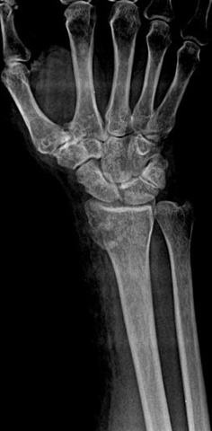 Fracture of Distal Radius