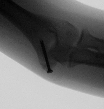 Repair of Condyle Fracture With Screw