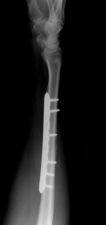Radial Shaft Fracture Fixation with Plate