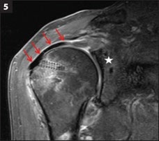 MRI 6 Months After SCR
