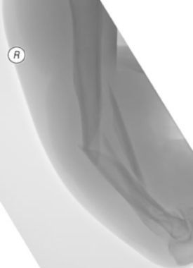Comminuted complex humerus fracture