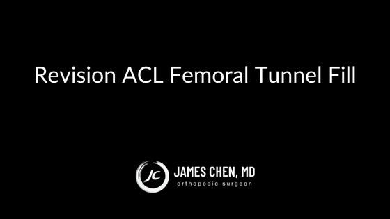 Revision ACL Femoral Tunnel Fill