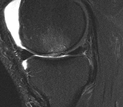 MRI 6 months after cartiform