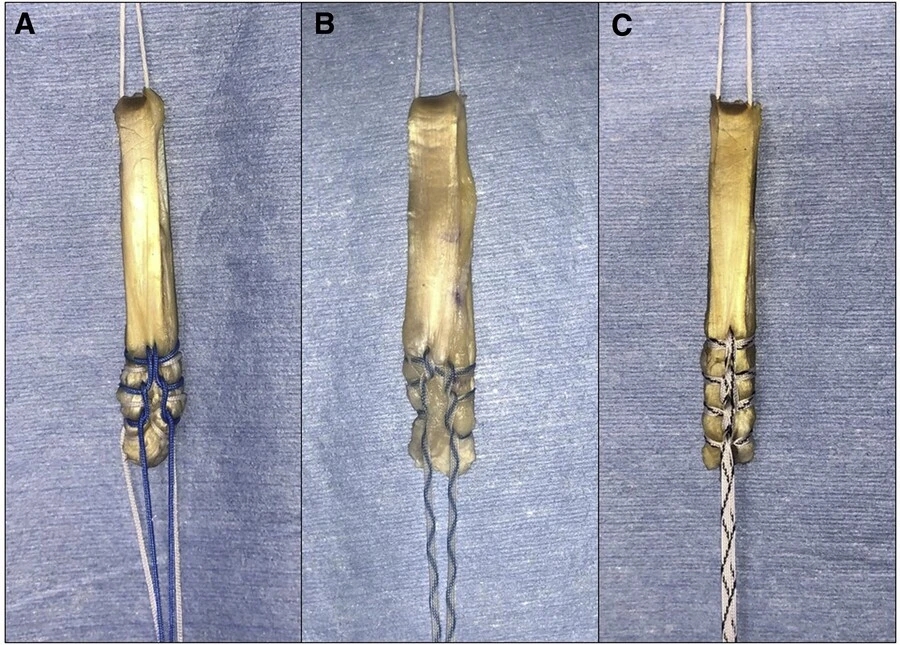 ACL Hamstring Graft