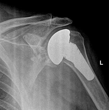 Total Shoulder Replacement With Metal Ball and Plastic Socket