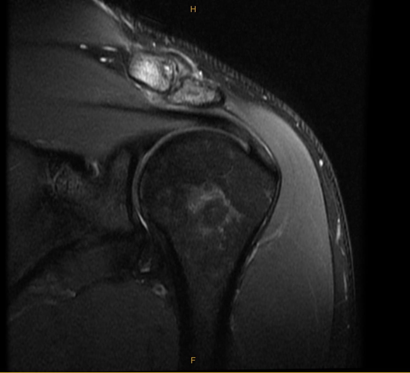 Preoperative MRI of patient clavicle to receive Distal Clavicle Resection (Mumford Procedure)