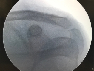 Tensioned cerclage repair of AC joint with bone tunnels
