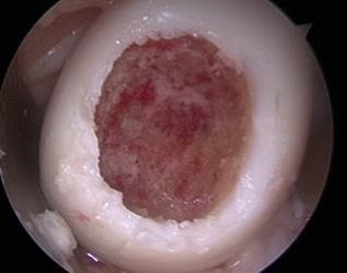Cartilage defect of medial femoral condyle