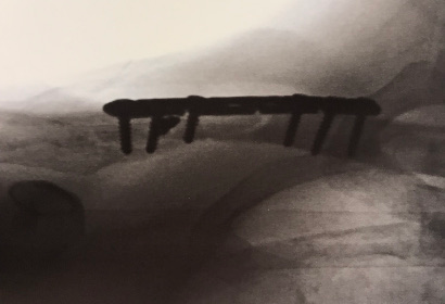 Clavicle Fracture Repair with Plate and Screws