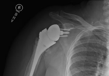 Reverse Shoulder Replacement for Non-united Fracture