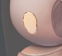 Filling of the Defect with BioCartilage