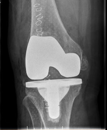knee replacement 1